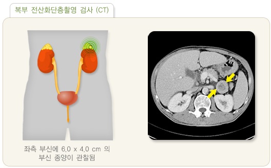  갈색세포종 원인, 증상, 진단, 치료, 예방 방법 및 합병증 알아보기