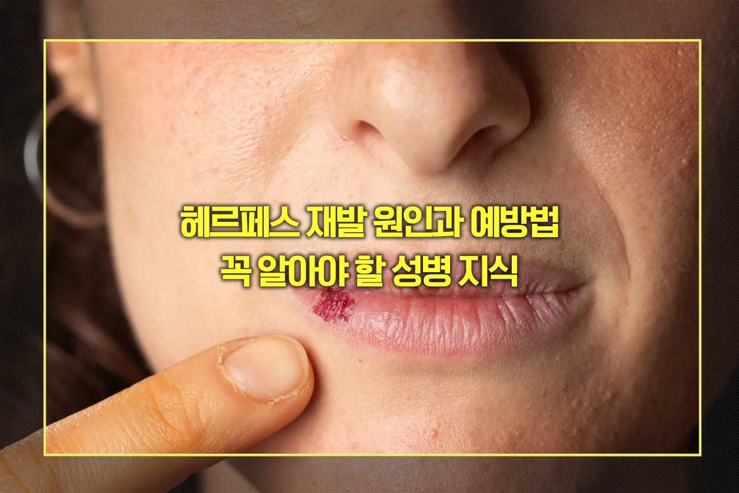 헤르페스재발-원인-예방법-성병지식