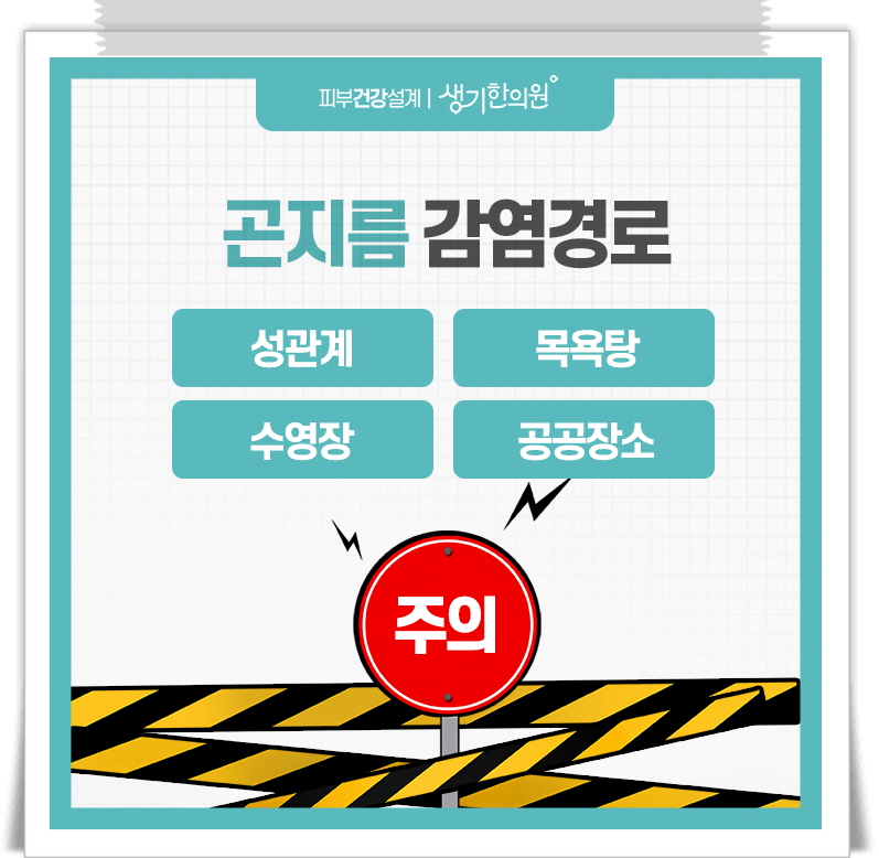항문곤지름 4
