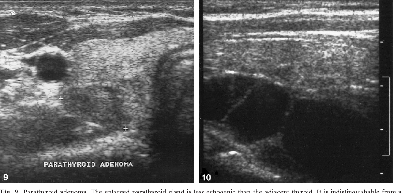 부갑상선(Parathyroid