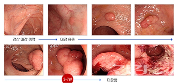 대장암 원인