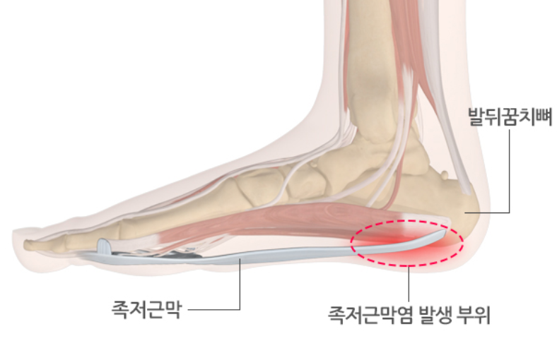 발바닥 통증인 족저근막염 해결하는 정말 효과적인 방법