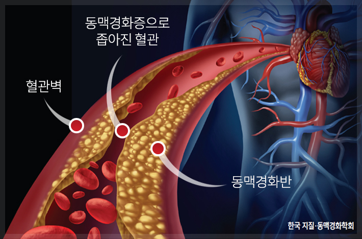  만성염증이 유발하는 9가지 질환