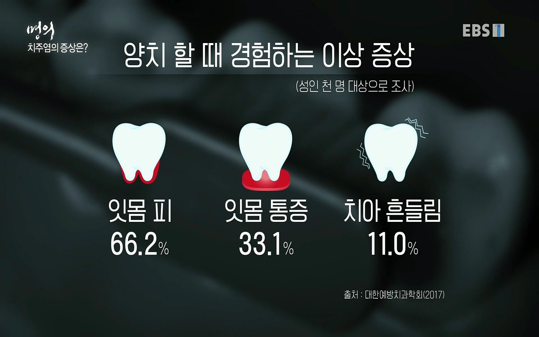 EBS 명의 헬스케어 - TV - 교육의 중심 EBS치주염이 코로나로 소홀해진 구강관리가 치아를 더 망가트리고 위험하게 만들며, 증상이 없기 때문에 특히 더 조심하고 치은염 단계에서 진행되지 않도록 예방해야한다 정의원 교수님과 치_20220505_151711.086.jpg
