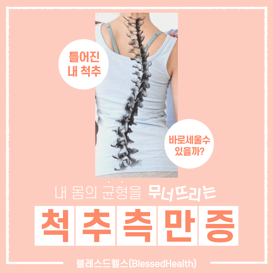  척추측만증(scoliosis) 정확한 진단과 관리가 필요하다!