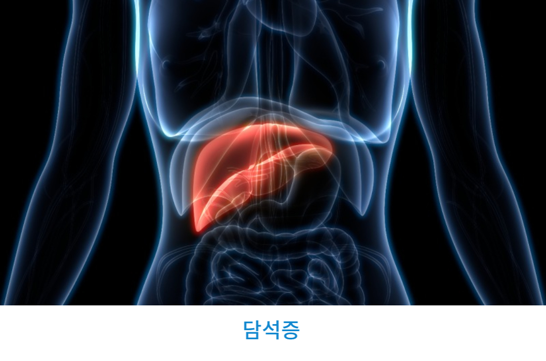 담석증