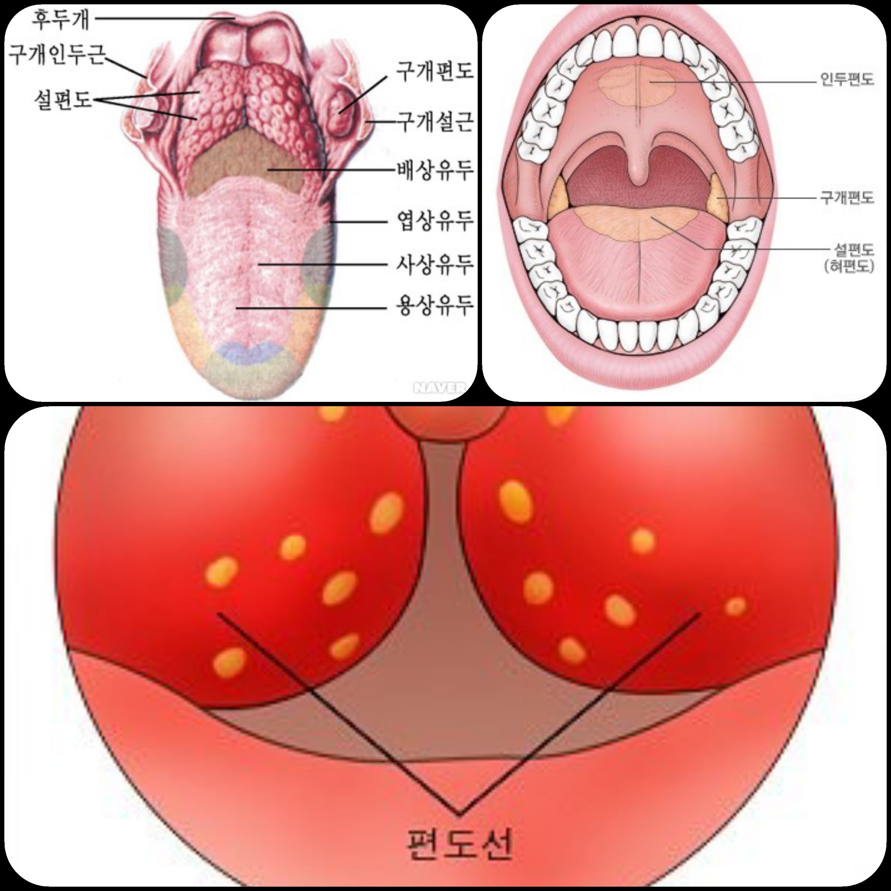  편도선염 초기에 고치는방법과 좋은 음식은?