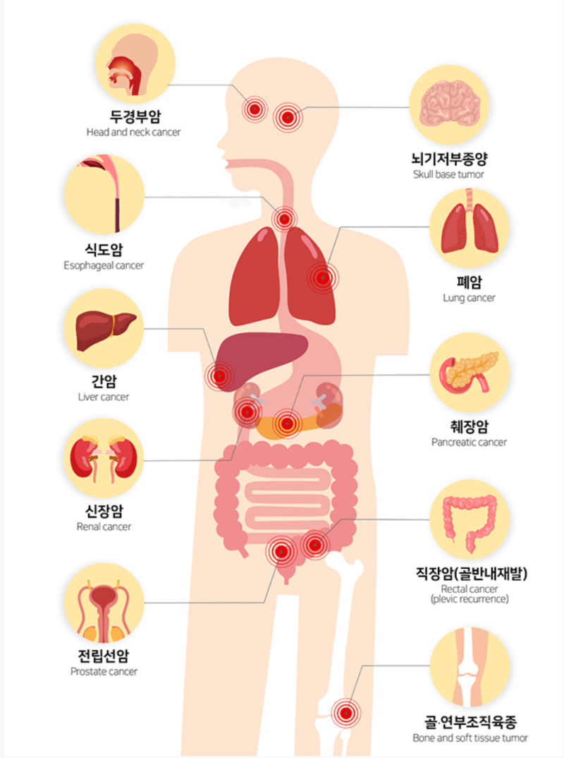 중입자치료법-치료가능한-암종류-출처 세브란스병원