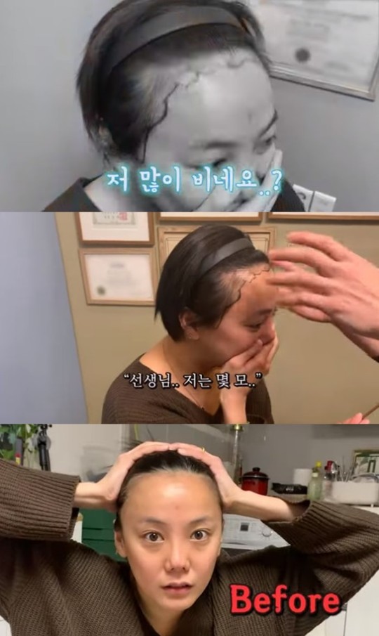  고은아, 머리 심는다 "4000모 이식, 시술 시간 4시간"