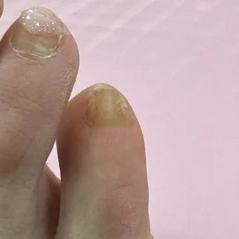 라셀턴 사용법과 가격 비교 발톱앰플 후기 정리해보기_23