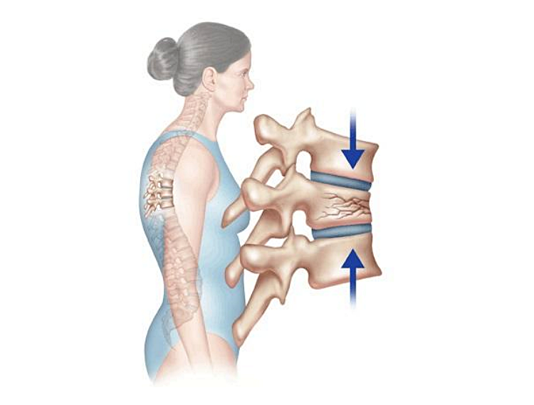 척추압박골절 치료기간 및 치료방법:골다공증 환자는 특히 주의