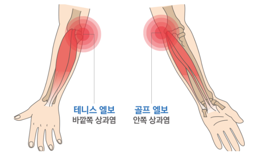 테니스 엘보와 골프 엘보