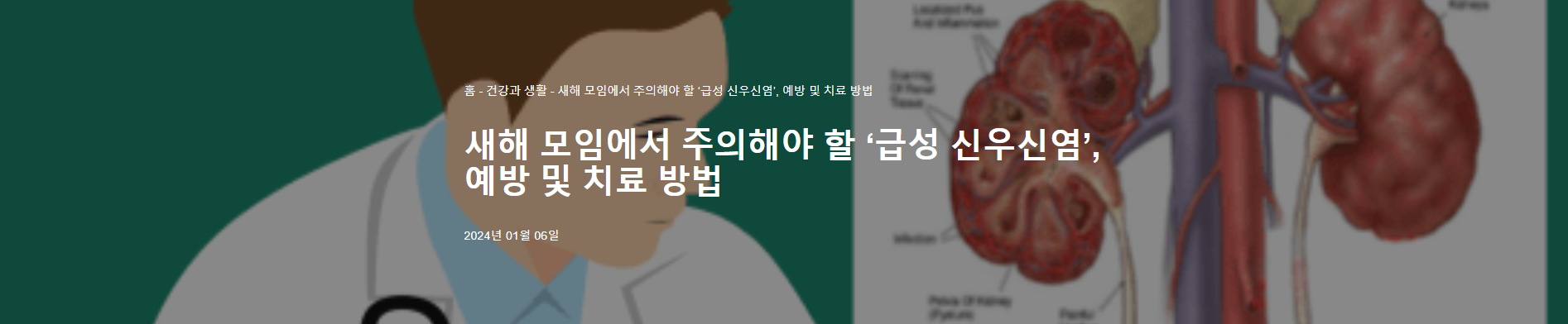 급성 신우신염의 대해서