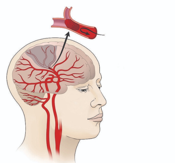 뇌졸중&amp;#44; 뇌출혈&amp;#44; 뇌경색의 차이점1