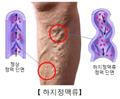 하지정맥류 증상의 환자 다리 모습