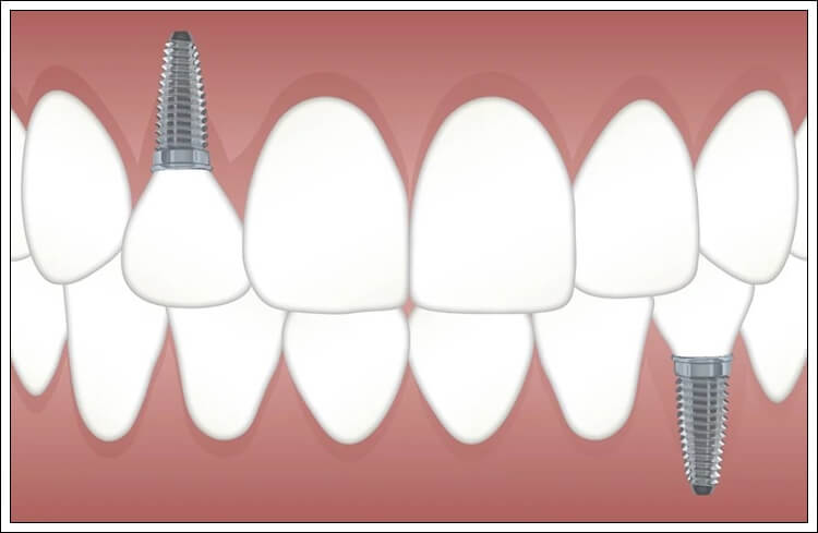치아 임플란트란?