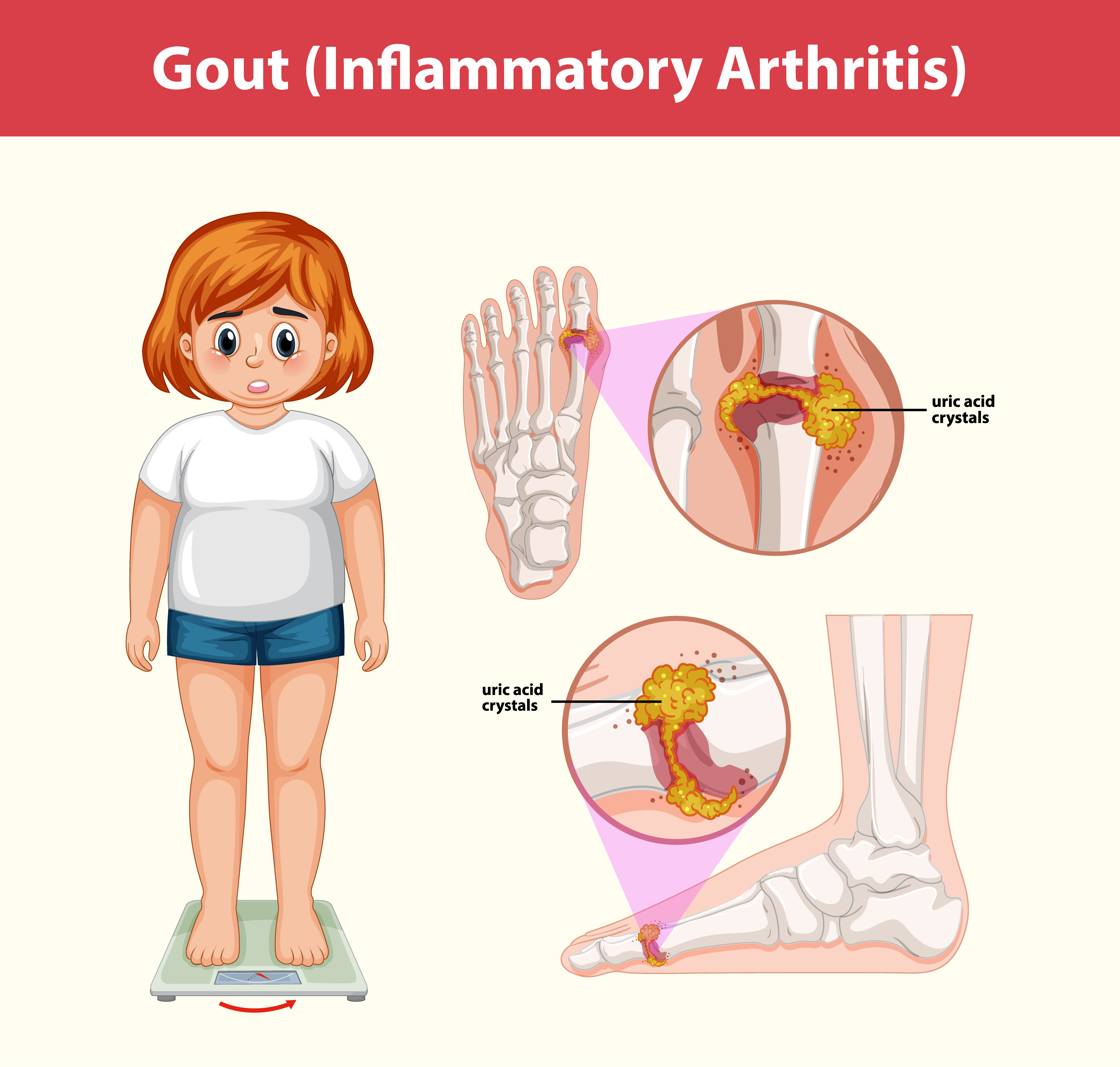 통풍의 원인과 형상을 표현한 이미지 (gout (inflammatory arthritis) medical information)