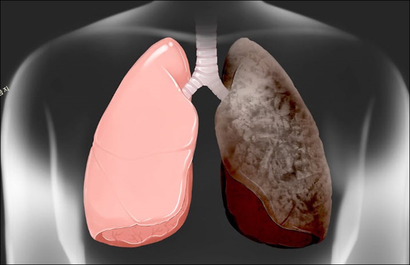 폐섬유화증