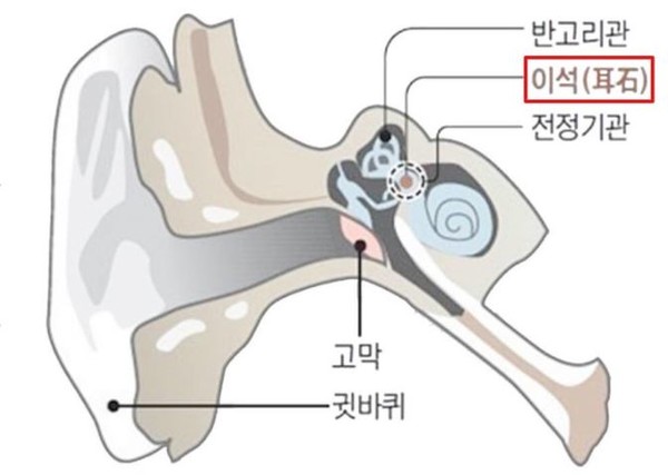 이석증 사진