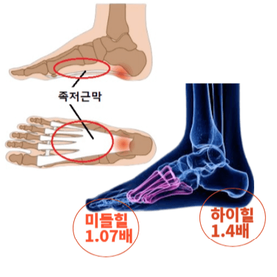 플랫슈즈를 잘 못 신었을떄 발생할수 있는 상황 사진