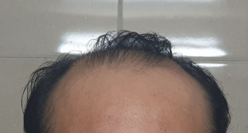 탈모약 복용을 시작한 날.2020.9.4.