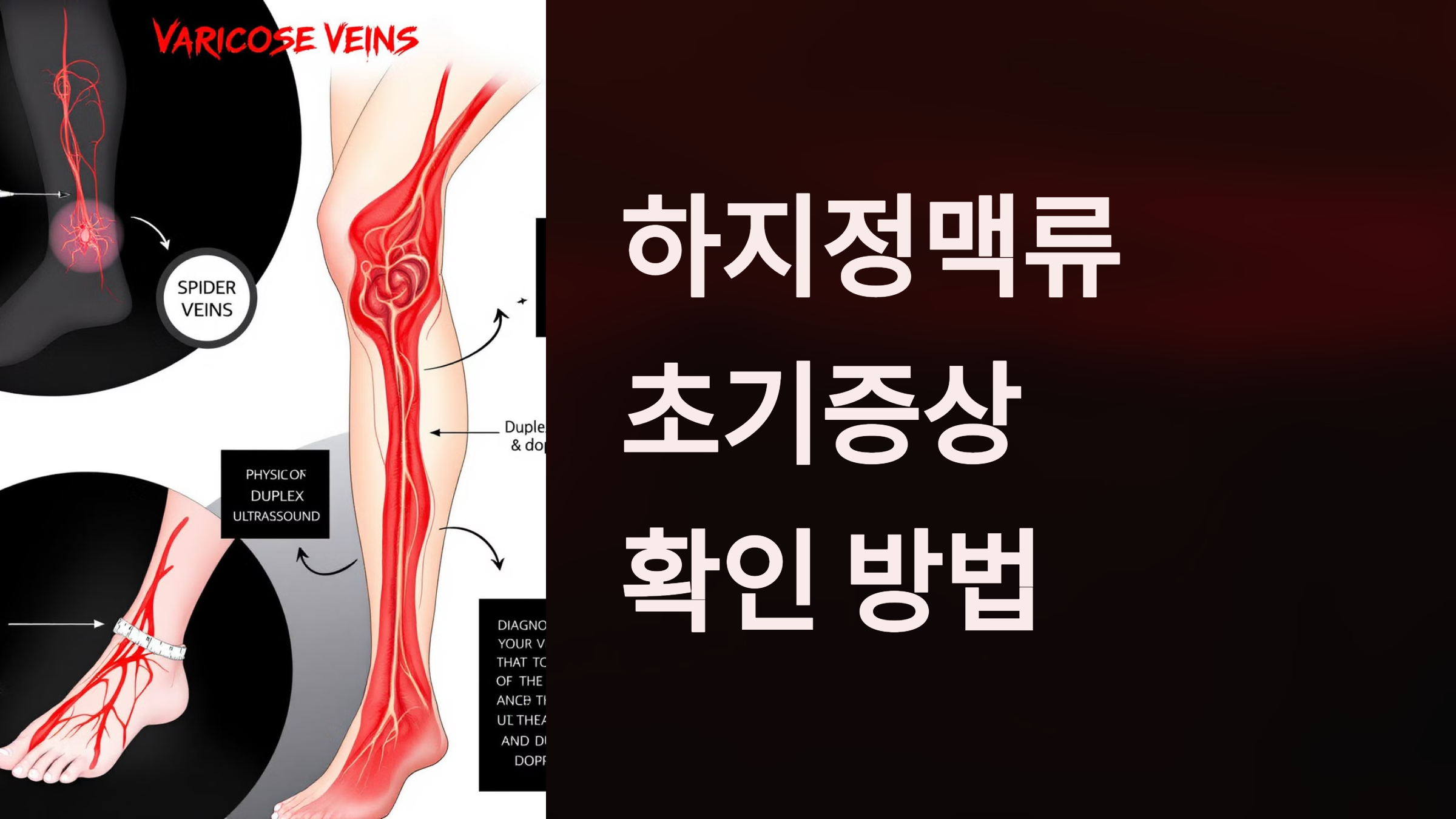 하지정맥류 초기증상 확인 방법 PPT 이미지