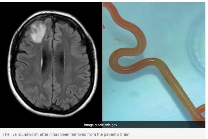 호주 여성 뇌에서 살아있는 기생충 세계 최초 발견 VIDEO: Live parasitic worm found in Australian woman’s brain in world first