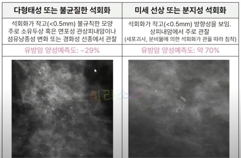 악성 유방 미세석회화 사진들. 다형태성 또는 불균질한 석회화&amp;#44; 미세 선상 또는 분시성 석회화.