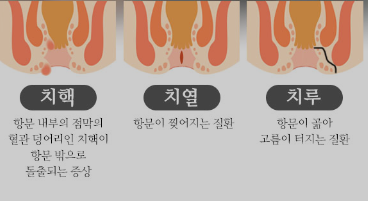  치질 증상 및 치질 수술을 해야 하는 경우