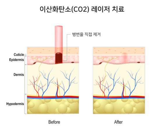 편평사마귀-치료-통증-재발-가격-보험