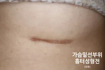 흉터전용 치료 추천 스카덤 겔 효능효과_12