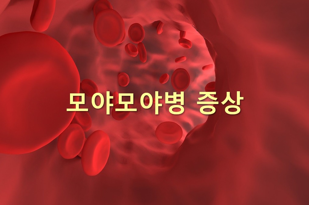  모야모야병 증상과 모야모야병 완치 가능성