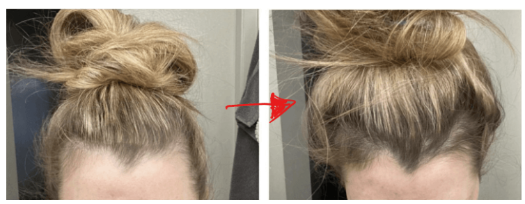 female hairloss treatment