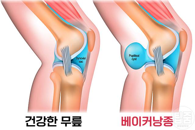 종아리 통증 원인 종아리가 땡기고 아파요 베이커낭종