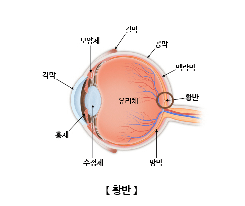 황반변성-황반