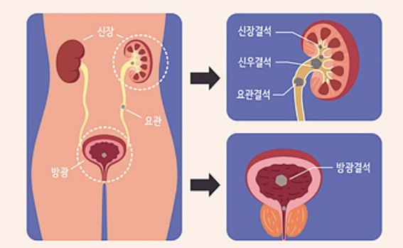 왼쪽 옆구리 통증 의심되는병 3