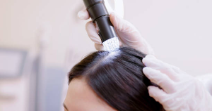 Treatment Methods Based on the Progression of Hair Loss.