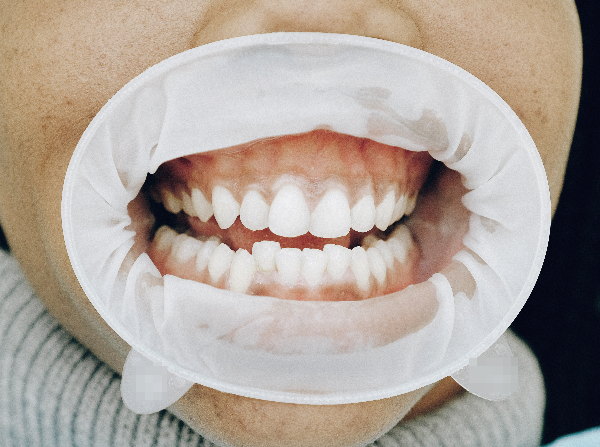  잇몸 까짐