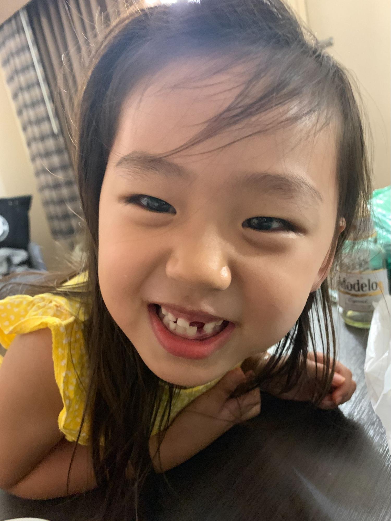 미국 횡단 여행 중 6살 앞니 발치
