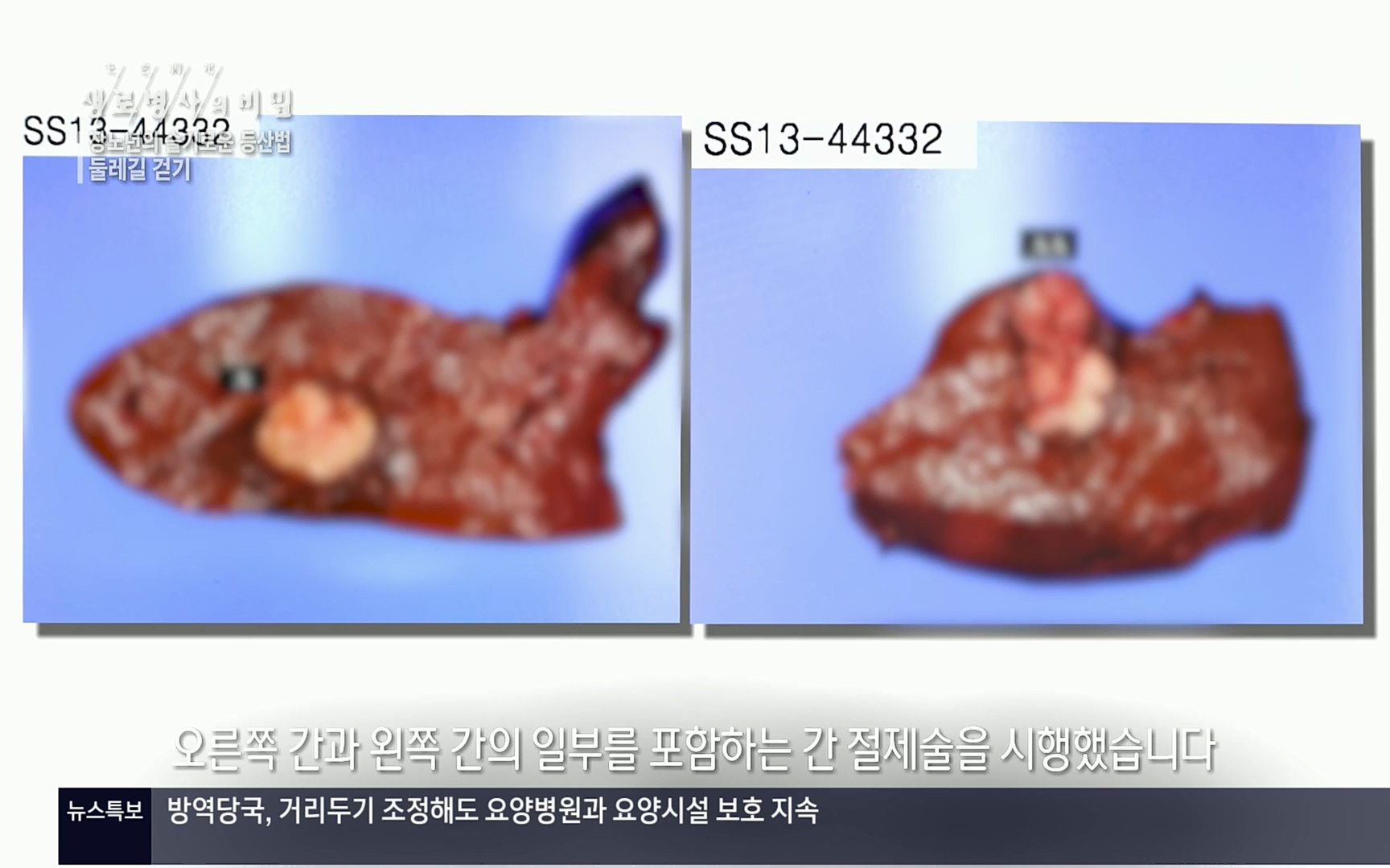 생로병사의 비밀.E816.220413p.H264-F1RST.mp4_20220414_192653.514.jpg