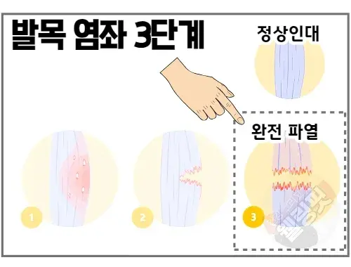 발목-염좌-3단계