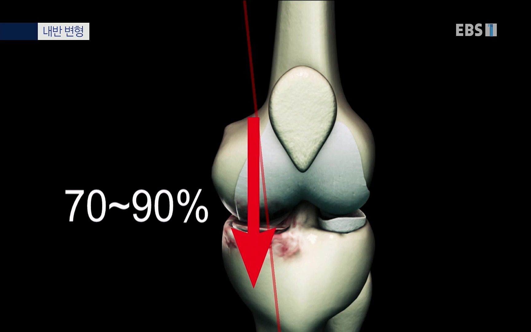EBS 명의 헬스케어 - TV - 교육의 중심 EBS무릎 건강 프로젝트 2부 새 무릎으로 사는 법 .mp4_20220726_202343.320.jpg