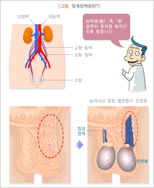 정계 정맥류의 의미