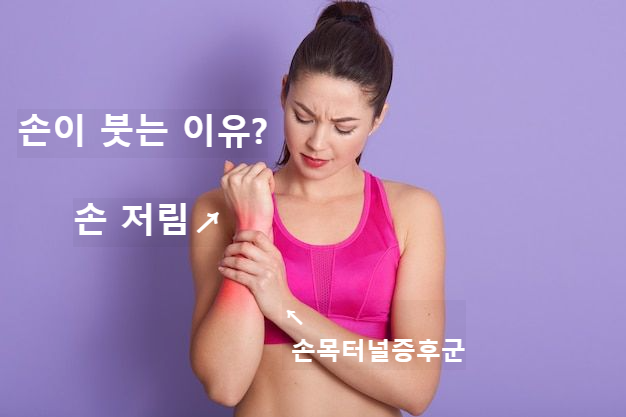  "손이 붓는 이유" 이것 때문에? 원인 및 관리방법 - 손 저림, 손목터널 증후군, 손 부종