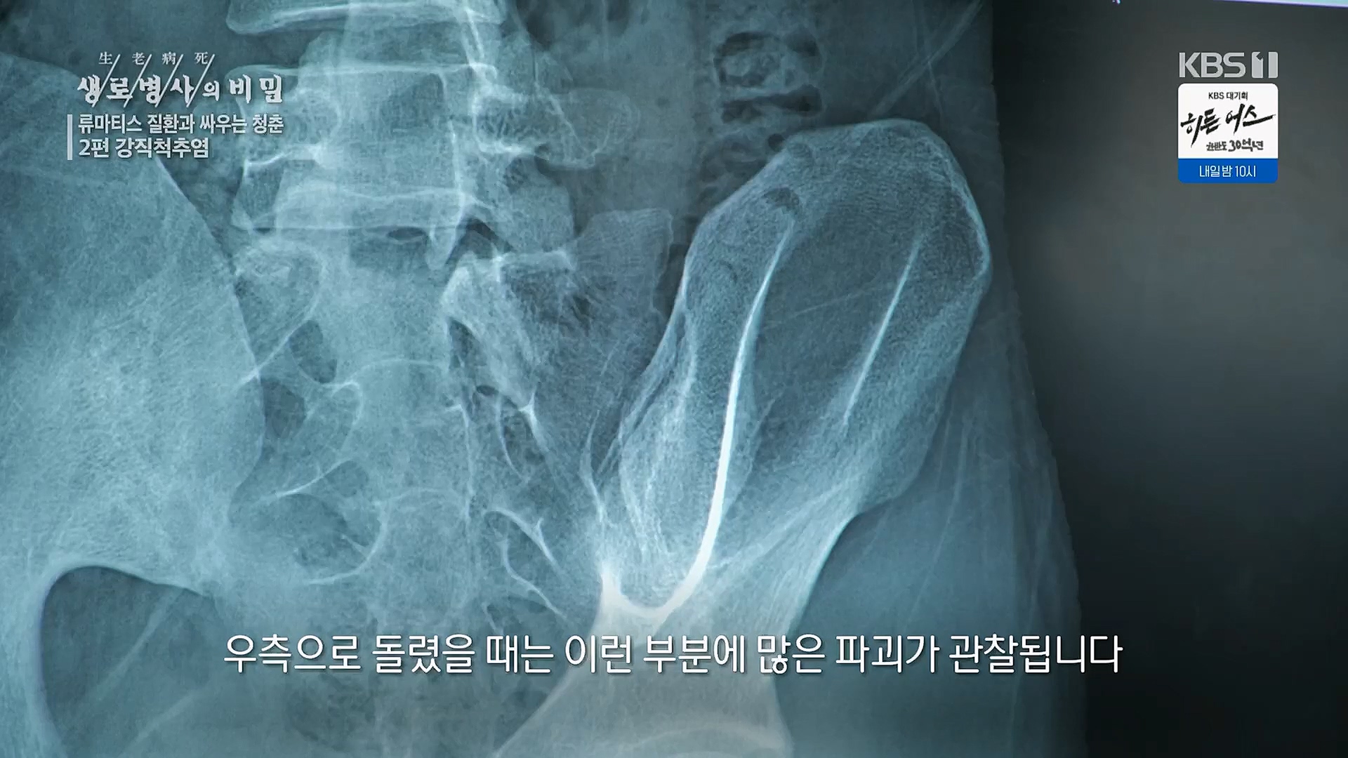 생로병사의 비밀.E861.230322p.H264-F1RST.mp4_20230323_204408.821.jpg