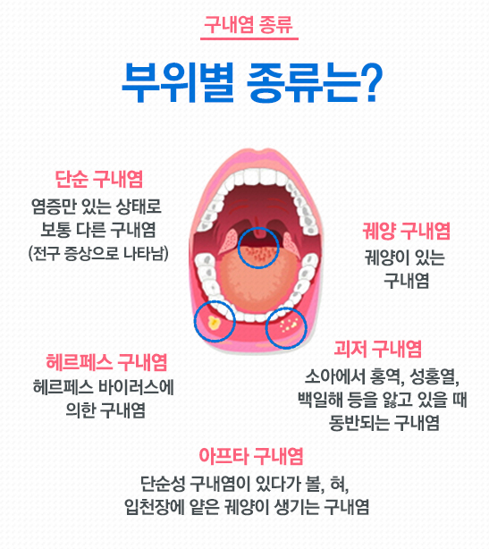 구내염 원인 빨리 낫는법 구내염 원인 빨리 낫는법