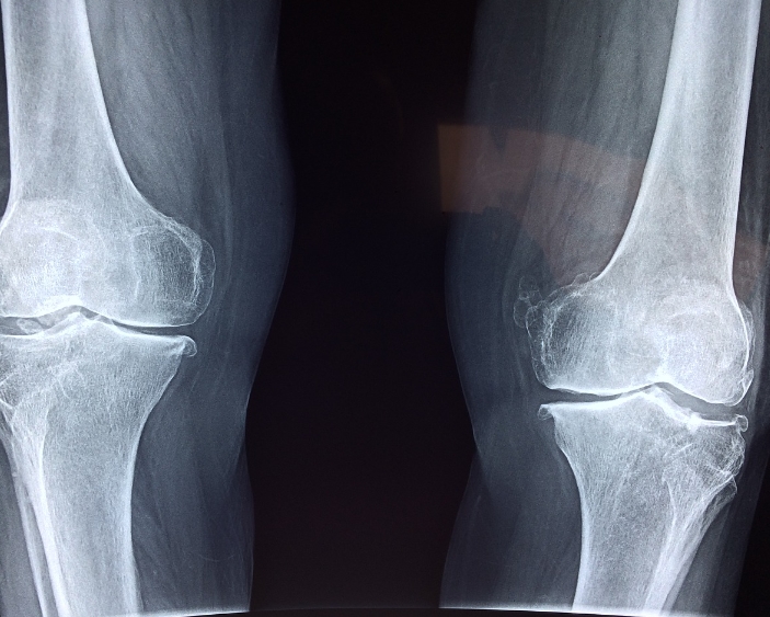 무릎관절이 안좋을 때 나타나는 중요한 증상들3