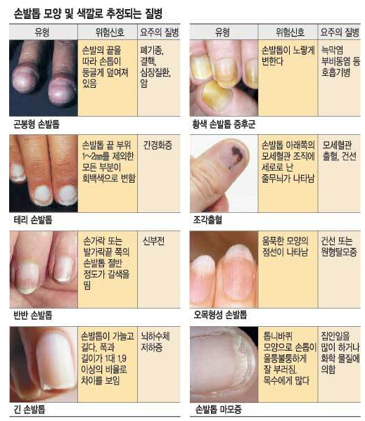  손톱으로 알아보는 건강 상태