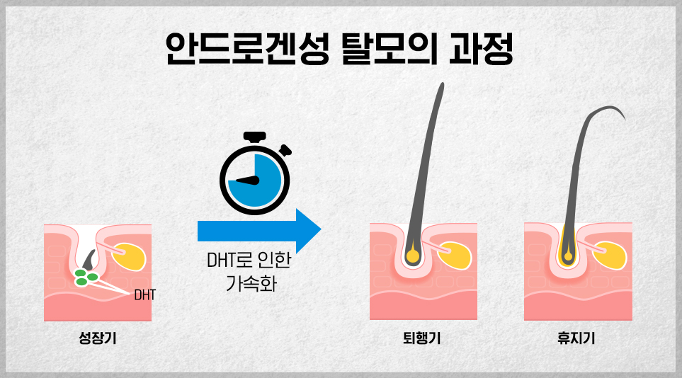 탈모를 가속화하는 안드로겐성 탈모 과정