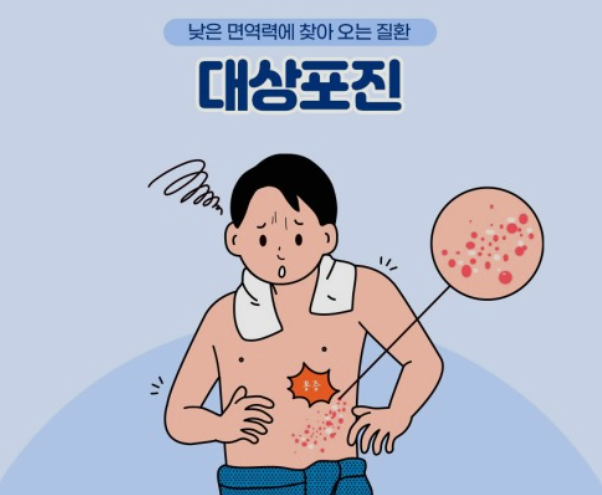  신경계 질환, 대상포진